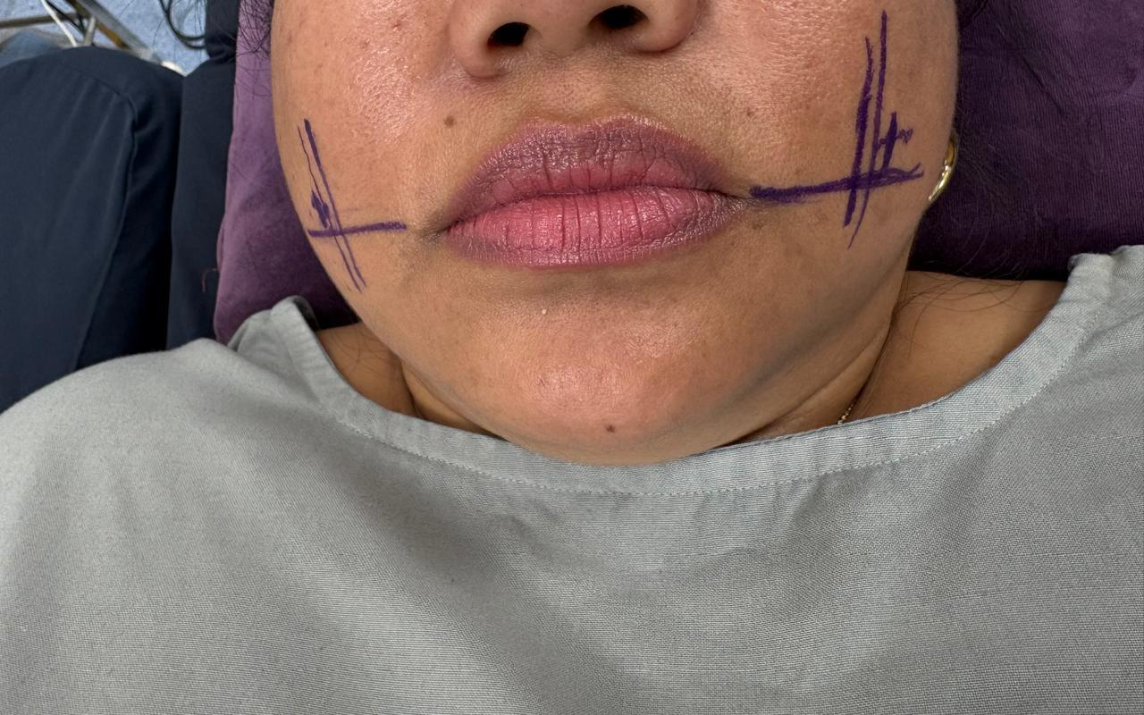 Before Dimpleplasty