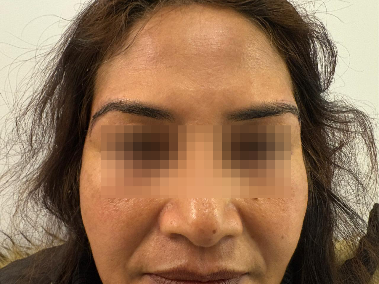 After Browpexy