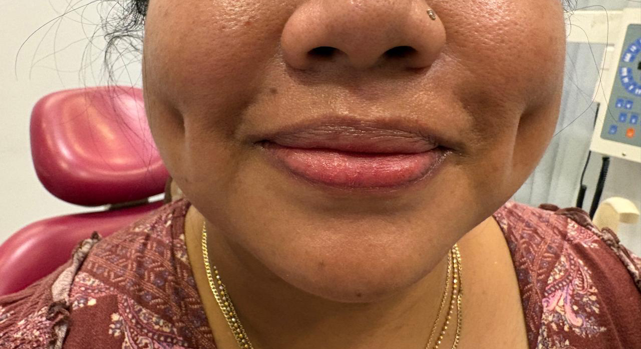 After Dimpleplasty